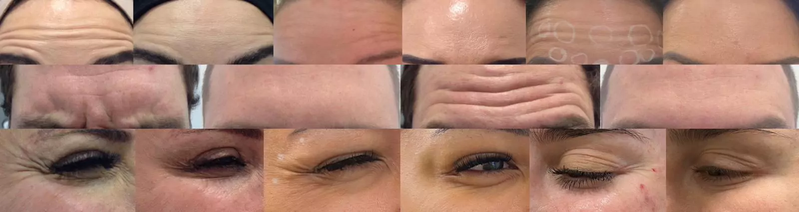 before and after images of anti wrinkle treatments
