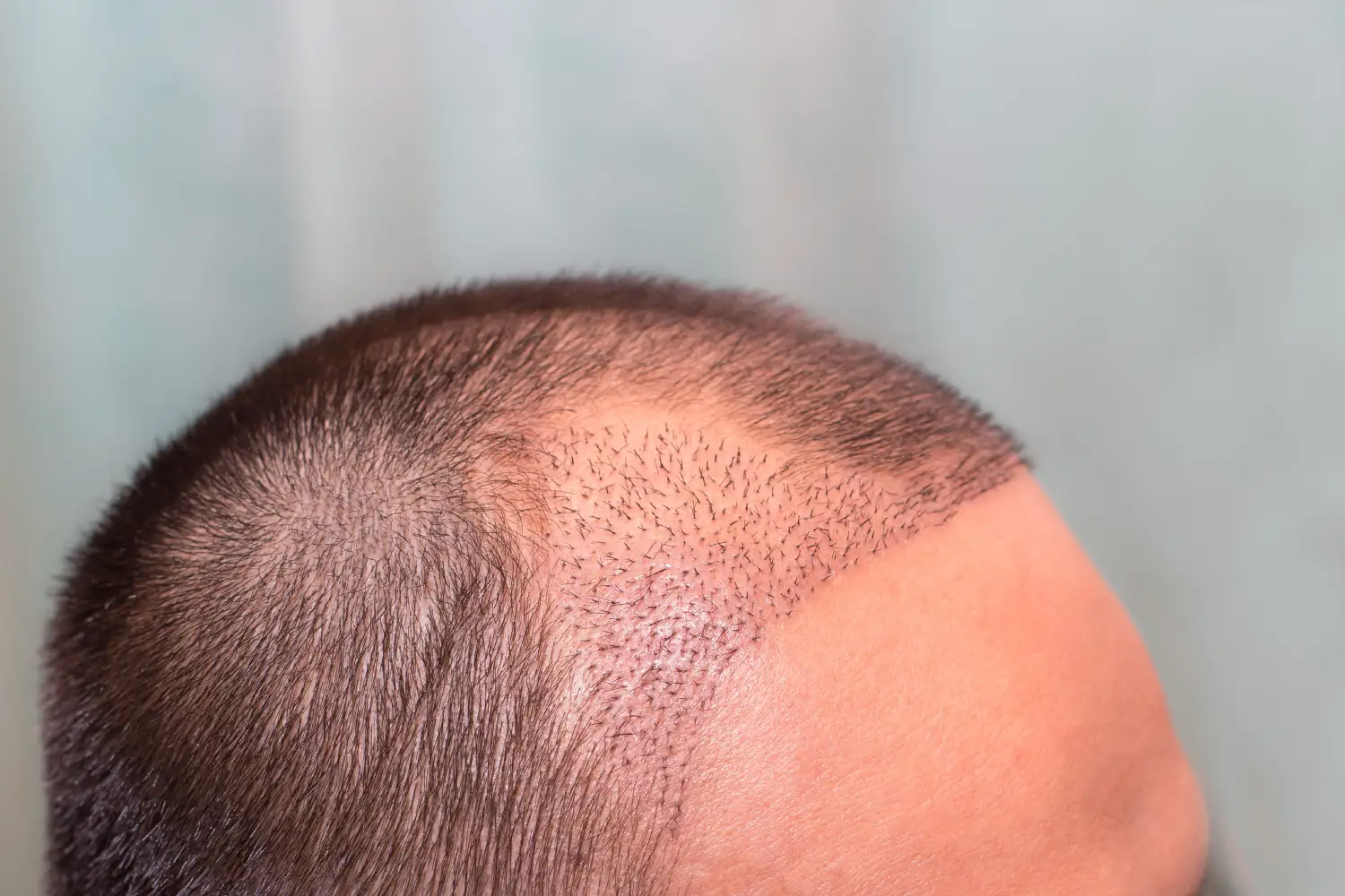 How Much Does an FUE Hair Transplant Cost in Australia? 3