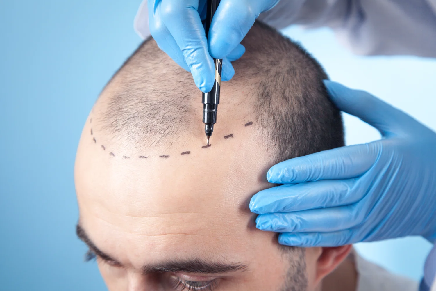 How Much Does an FUE Hair Transplant Cost in Australia? 1
