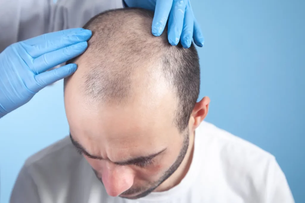 Is a Hair Transplant Right for You? Assessing Candidacy & Expectations 5