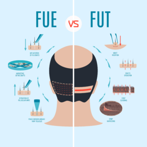 What is a Hair Transplant? The Ultimate Guide To Hair Transplants in Australia 1