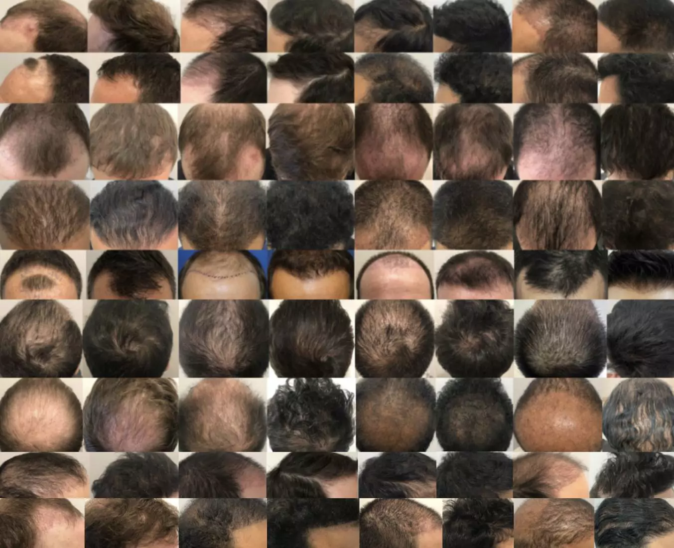 hair transplants before and after slideshow
