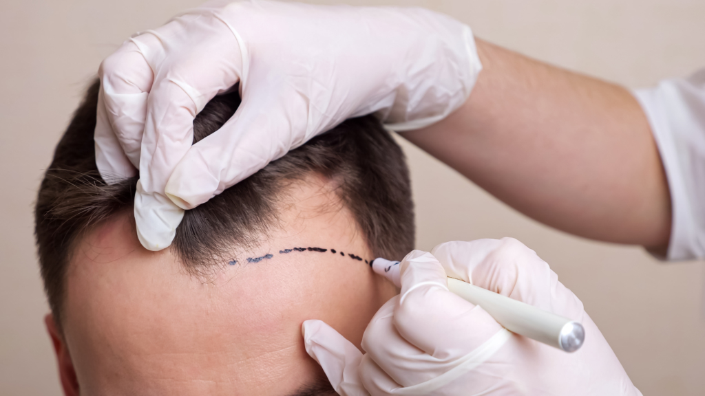 How to Choose the Best Hair Transplant Clinic in Australia 14