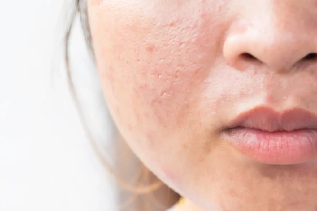 Understanding the Different Types of Acne Scars & Treatment Options 2