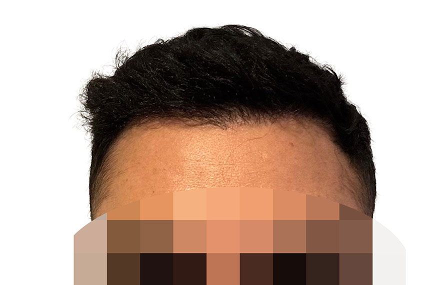 Hair Transplants 2