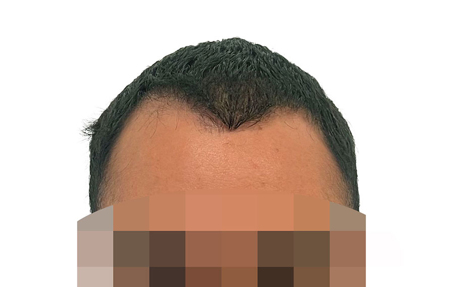 Hair Transplants 1