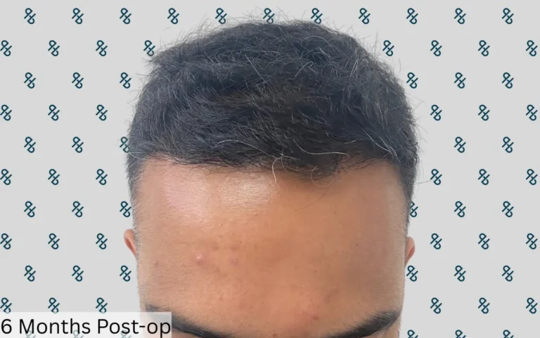 Hair Transplants 6
