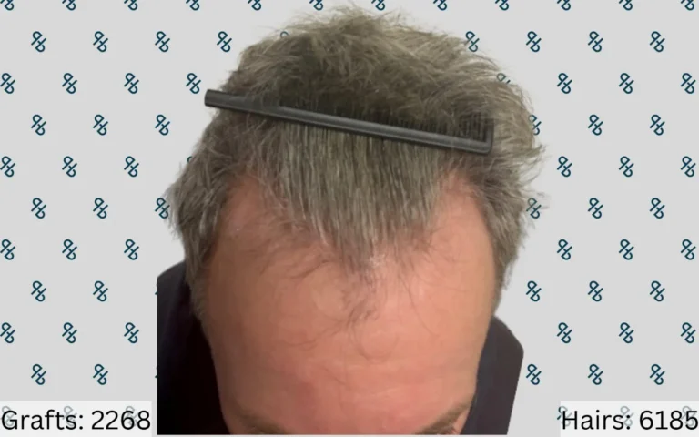 Hair Transplants 7
