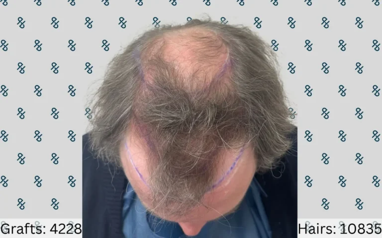 Hair Transplants 11