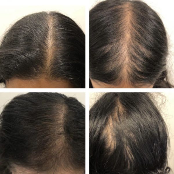 Female PRP Hair Loss Before and After Photo