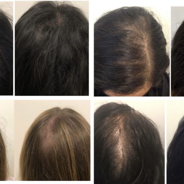 Female PRP Hair Loss Before and After Photo