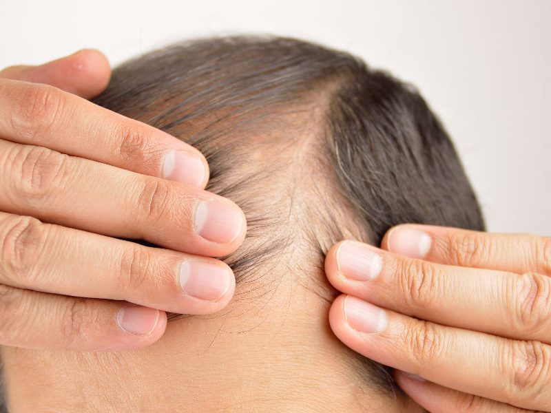 Male suffering from hair loss and thinning