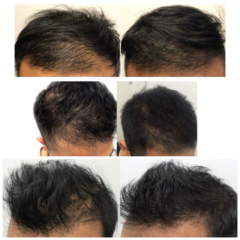 Male PRP Before and After Photo