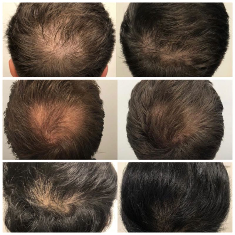 Male PRP Before and After Photo
